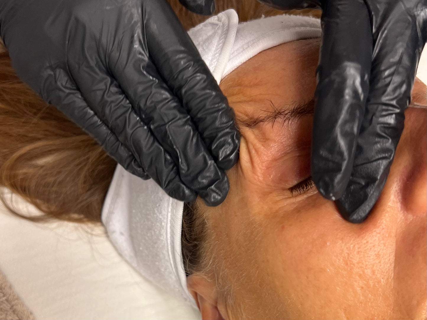 Pulizia Viso con acidi - PEELING
